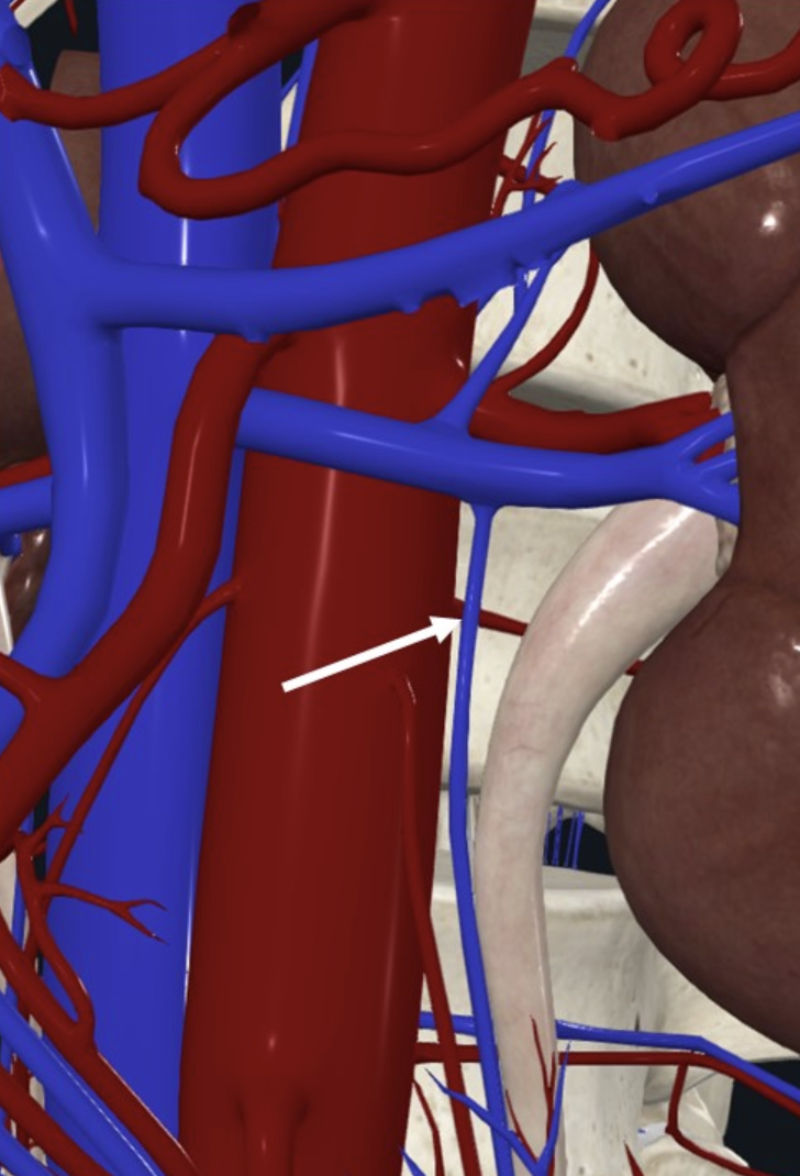 Left gonadal vein (חץ לבן); בצד שמאל מתנזק ל־Renal vein, ובצד ימין ל־IVC