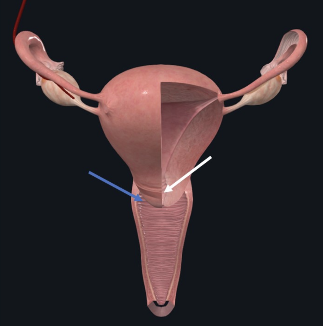 Lateral Fornix (חץ כחול); אזור ההתרחבות הפרוקסימלית של ה־Vagina המקיף את צוואר הרחם (חץ לבן). יש גם אנטריורי ופוסטריורי.