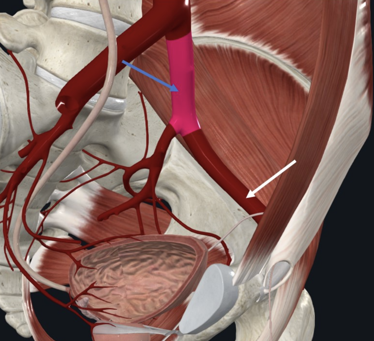 Left Common Iliac Artery (חץ כחול), הוא המקור ל־External iliac artery (חץ לבן)