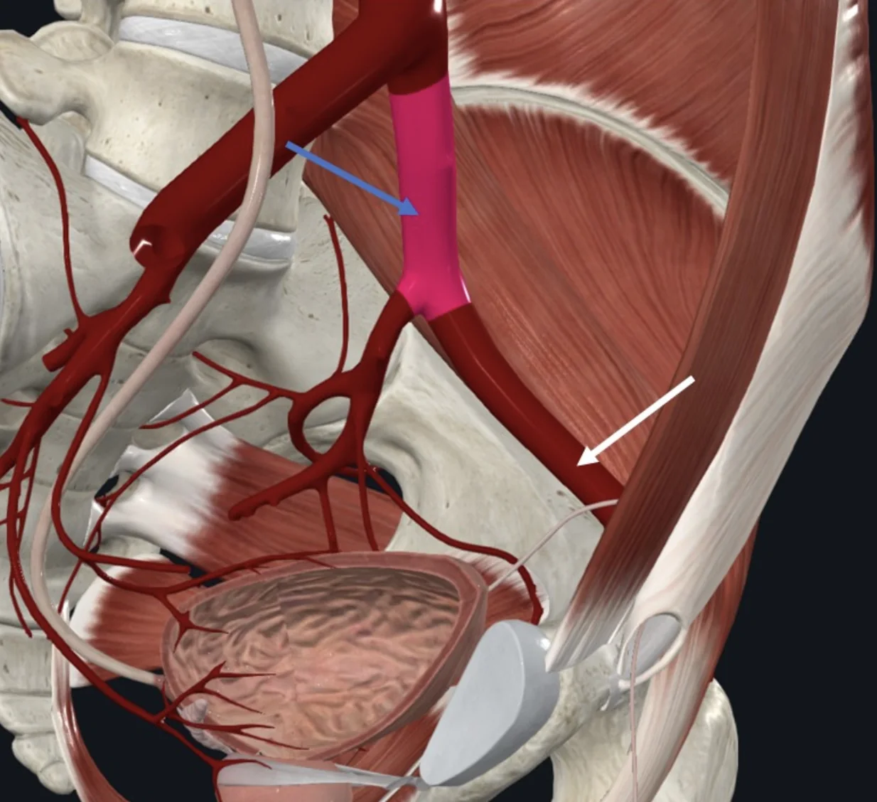 Left Common Iliac Artery (חץ כחול), הוא המקור ל־External iliac artery (חץ לבן)
