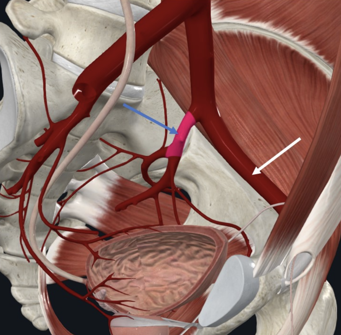 Left internal iliac artery