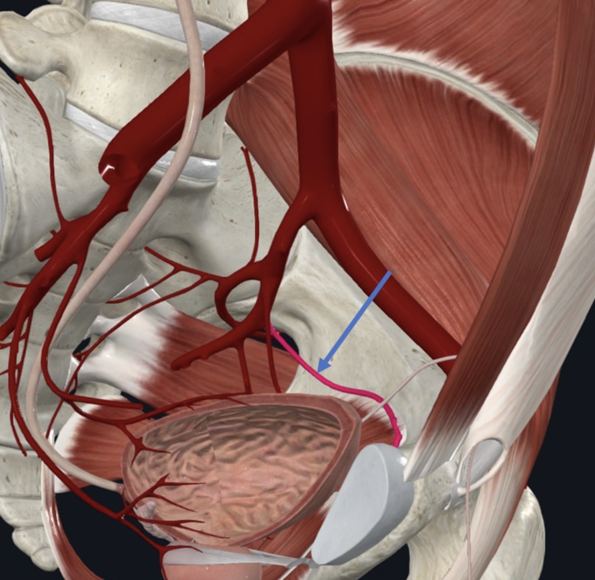 Left obturator artery. מקורו ב־internal iliac artery והוא עובר ב־Obturator foramen בדרכו לספק מבנים בירך