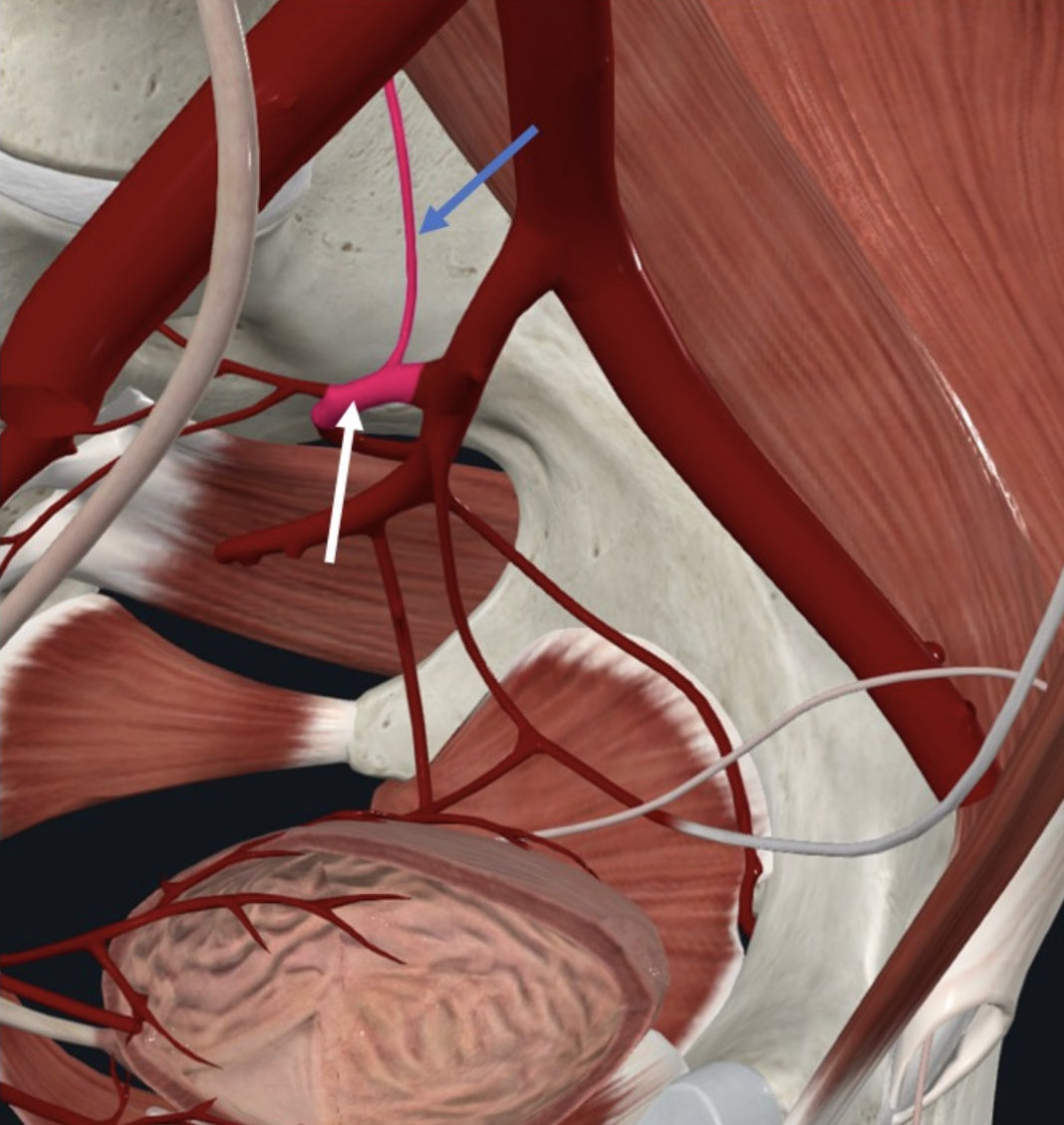 Iliolumbar Artery (חץ כחול). ה־Posterior division של ה־Internal Iliac Artery (חץ לבן)