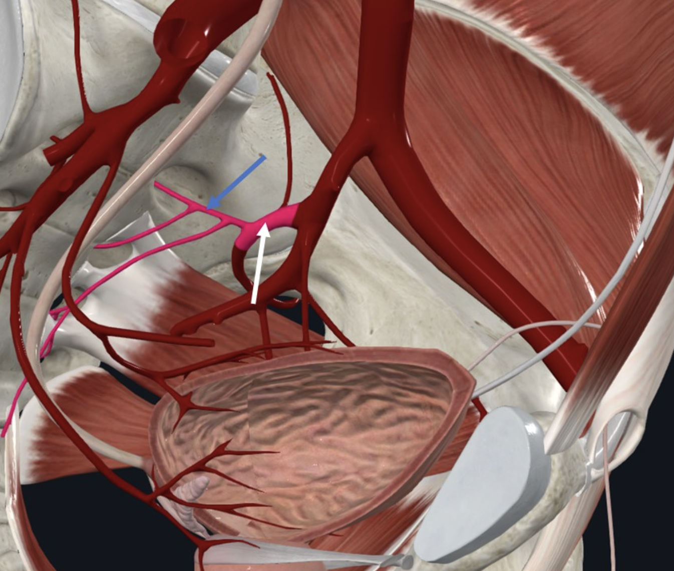 Lateral Sacral Artery (חץ כחול), שולח ענפים שחודרים לפורמנים של עצם הסקרום