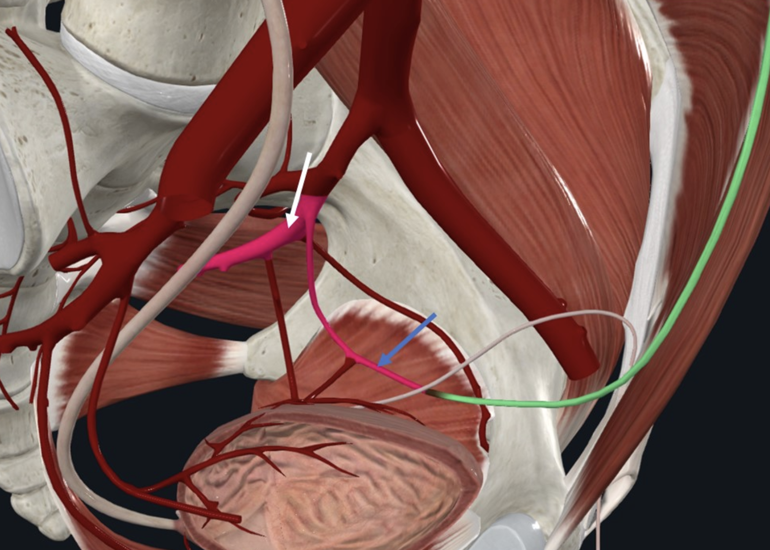 Umbilical Artery (חץ כחול), ה־Anterior divion של ה־Internal Iliac Artery (חץ לבן)
