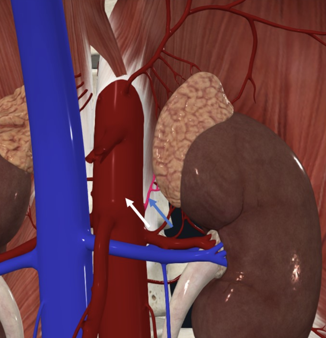 האאורטה (חץ לבן) היא המקור של ה־Middle Suprarenal Artery (חץ כחול)