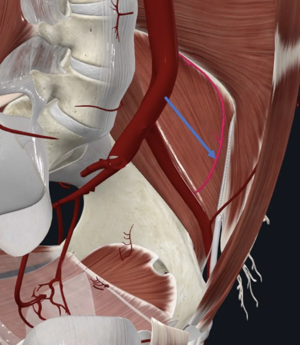 Deep Circumflex Iliac Artery (חץ כחול), מקורו ב־External iliac artery והוא מקיף את ה־Iliac fossa