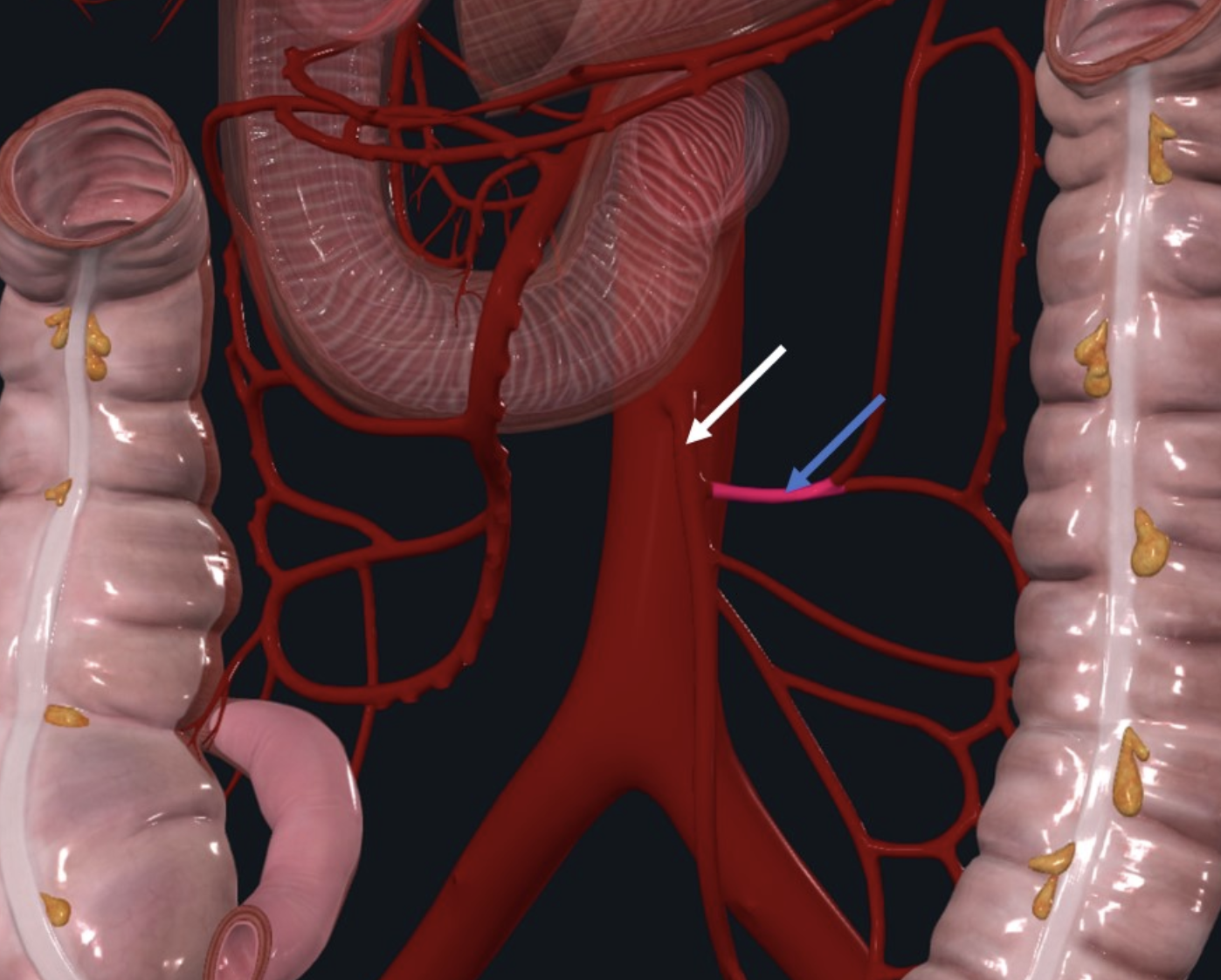 Left colic artery (חץ כחול), ו־Inferior mesenteric artery (חץ לבן)