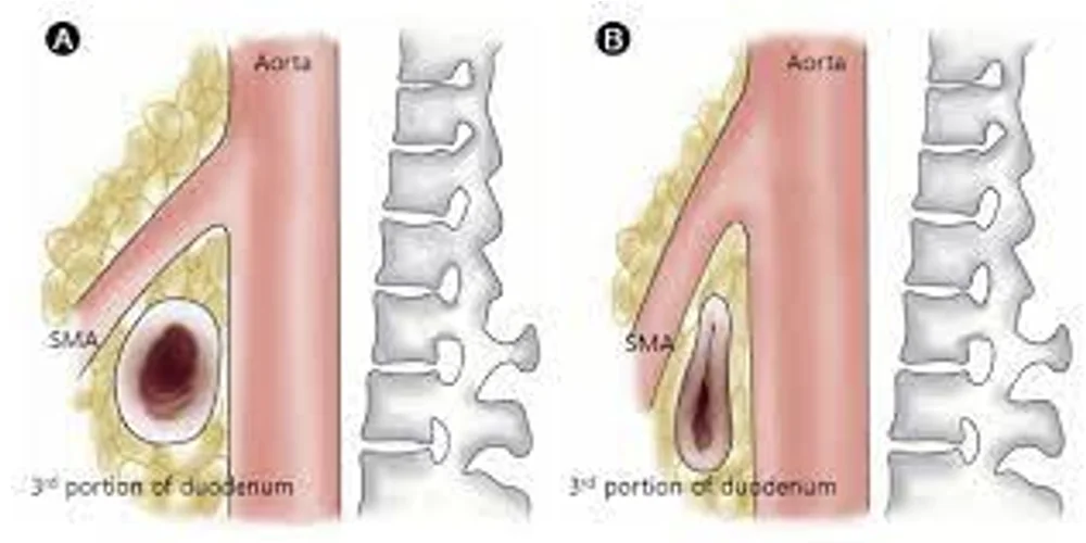SMA Syndrome