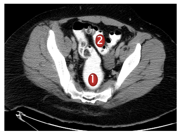 Rectum and Sigmoid colon