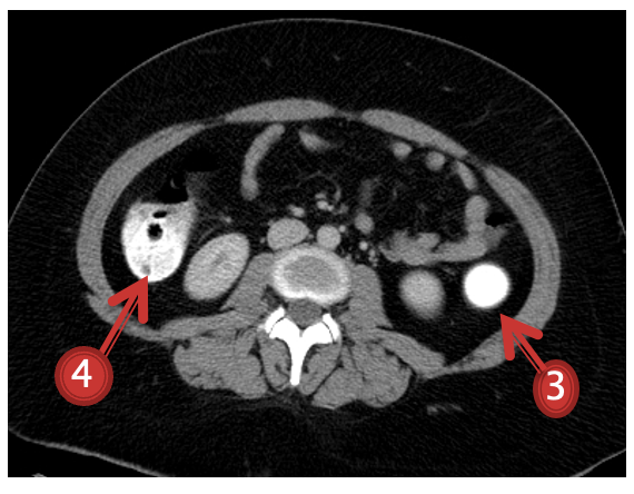 Descending and Ascending colon