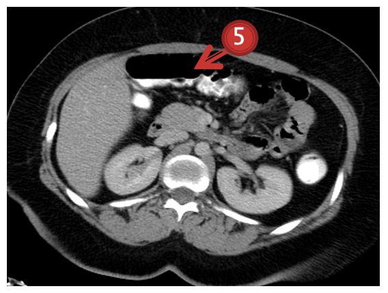 Transverse colon