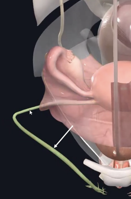 Round Ligament of the Uterus