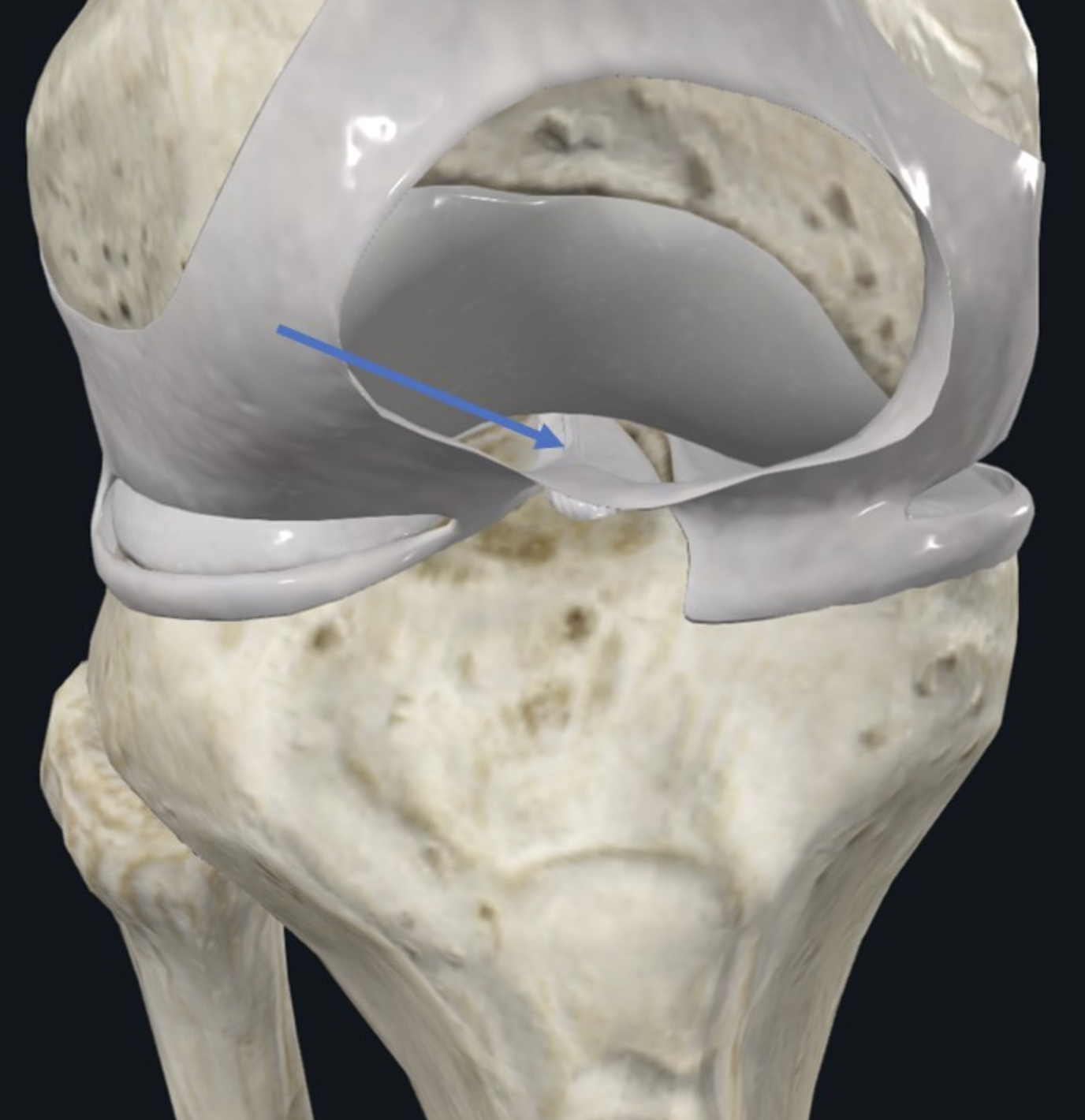 Infrapatellar synovial fold, אפשר מעבר של נוזל סינוביאלי בין האזור האנטריורי לאזור הפוסטריורי במפרק הברך