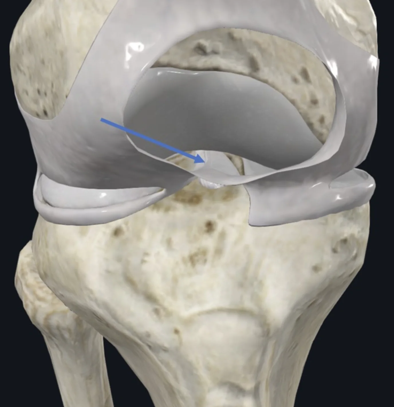 Infrapatellar synovial fold, מאפשר מעבר של נוזל סינוביאלי בין האזור האנטריורי לאזור הפוסטריורי במפרק הברך