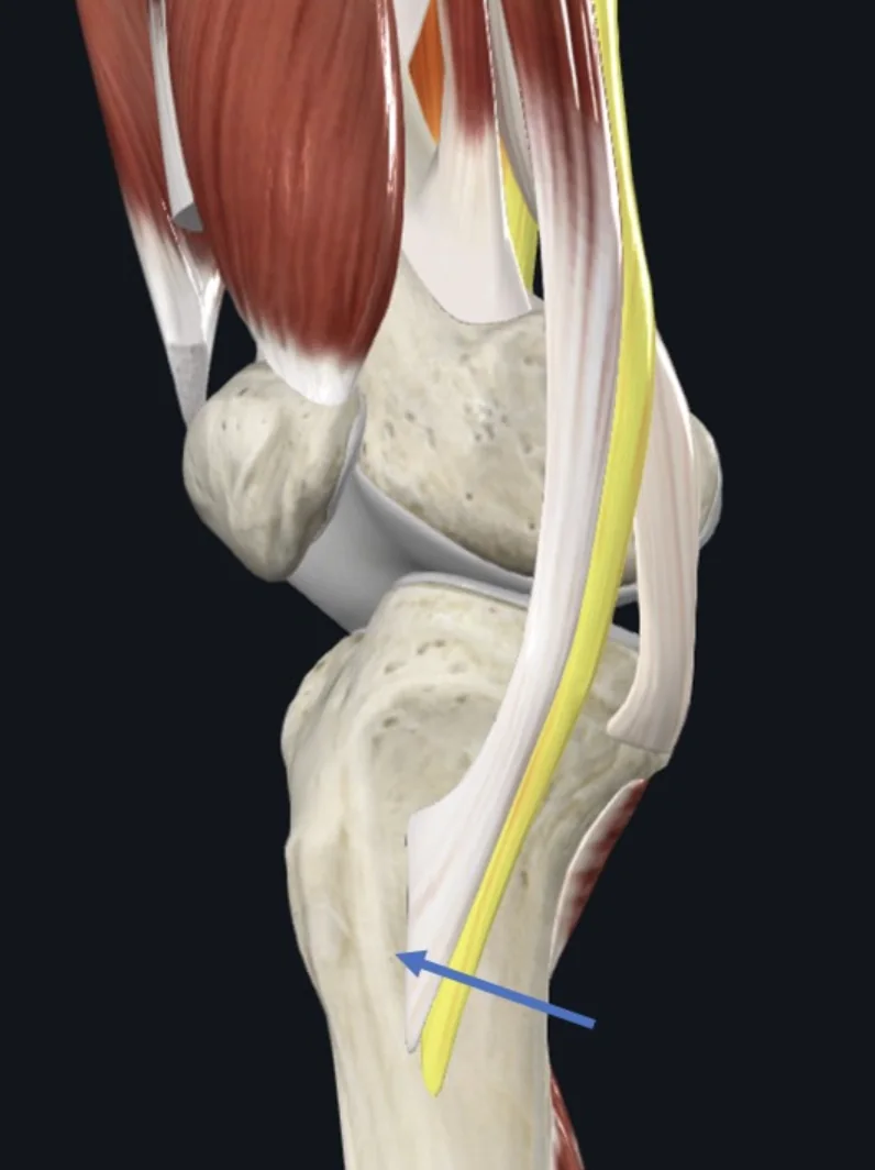 Pes Anserinus (חץ כחול), רק אחת משרירי ה־Hamstrings נאחז בה: Semitendinosus (מסומן בצהוב)