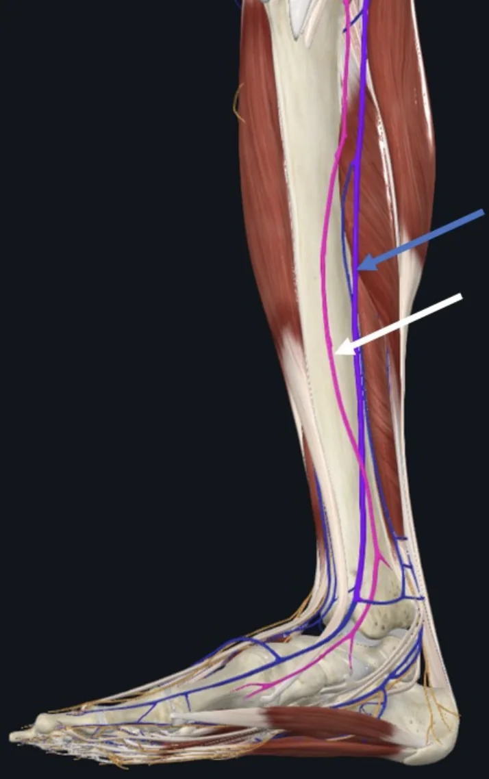 Great saphenous vein (חץ כחול), וריד שטחי גדול העובר במהלכו בשוק המדיאלי בדרכו להתנקז במשולש הפמורלי. ה־Saphenous nerve (חץ לבן) הוא עצב סנסורי המתלווה אליו במהלכו בשוק המדיאלי