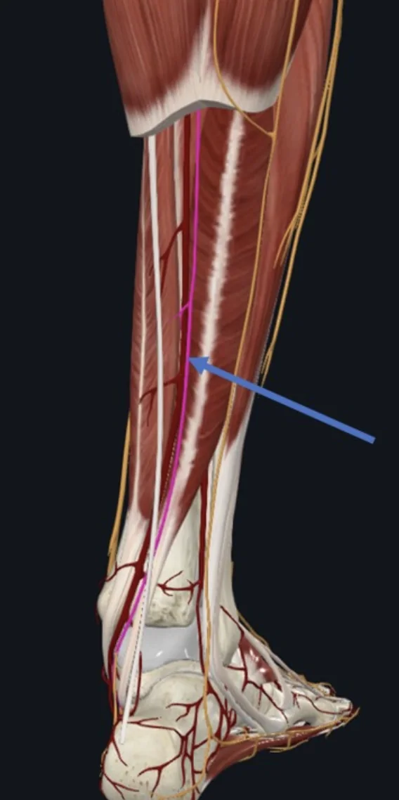 Tibial Nerve, חולף ביחד עם ה־Posterior Tibial Artery בין המדור השטחי למדור העמוק בשוק