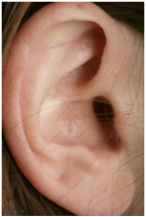 סכוך אלסטי באוזן החיצונית