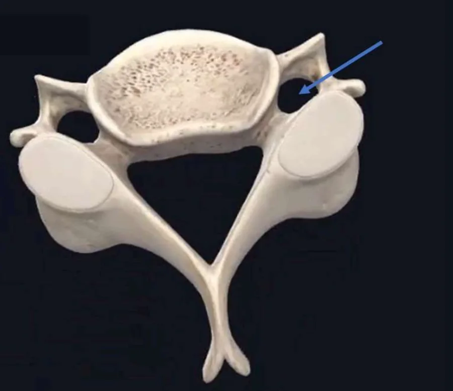 Foramen Transversarium - Vertebral Artery location