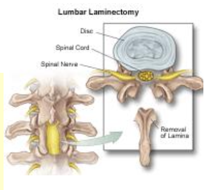 lumbar laminectomy