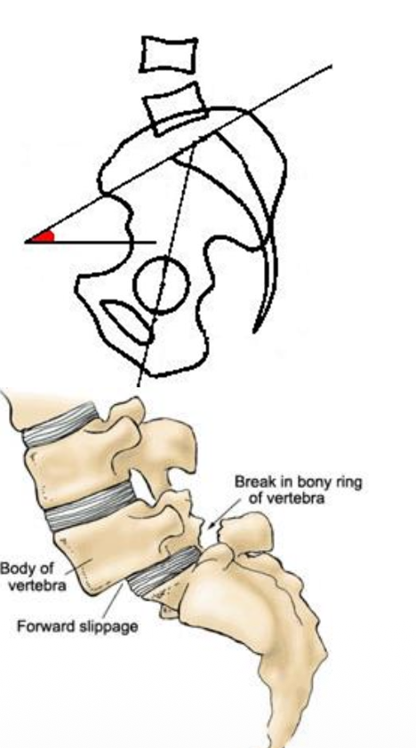 Sacral inclination angle & Spondylolisthesis