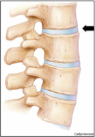 סכוך סיבי בגב