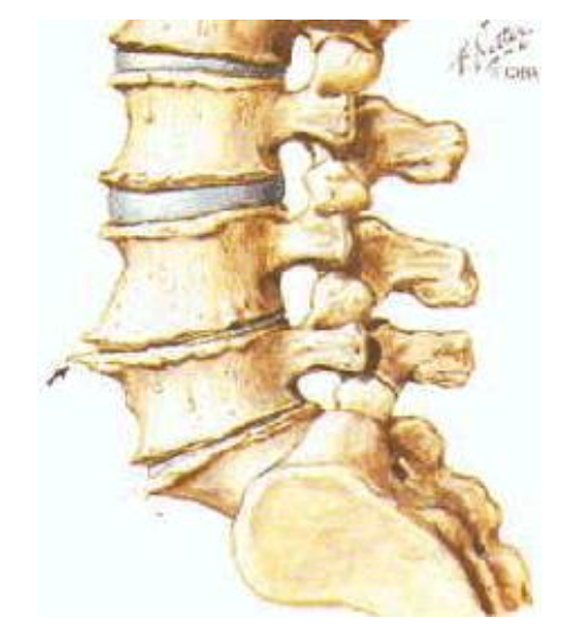 osteophytes