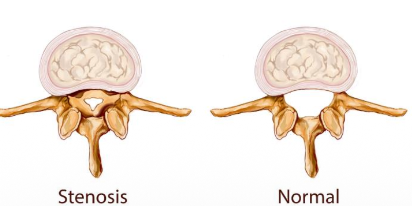 stenosis