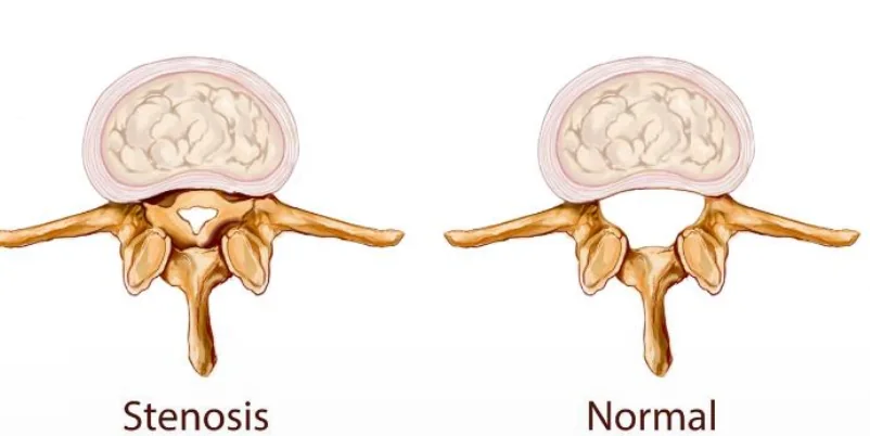 Stenosis