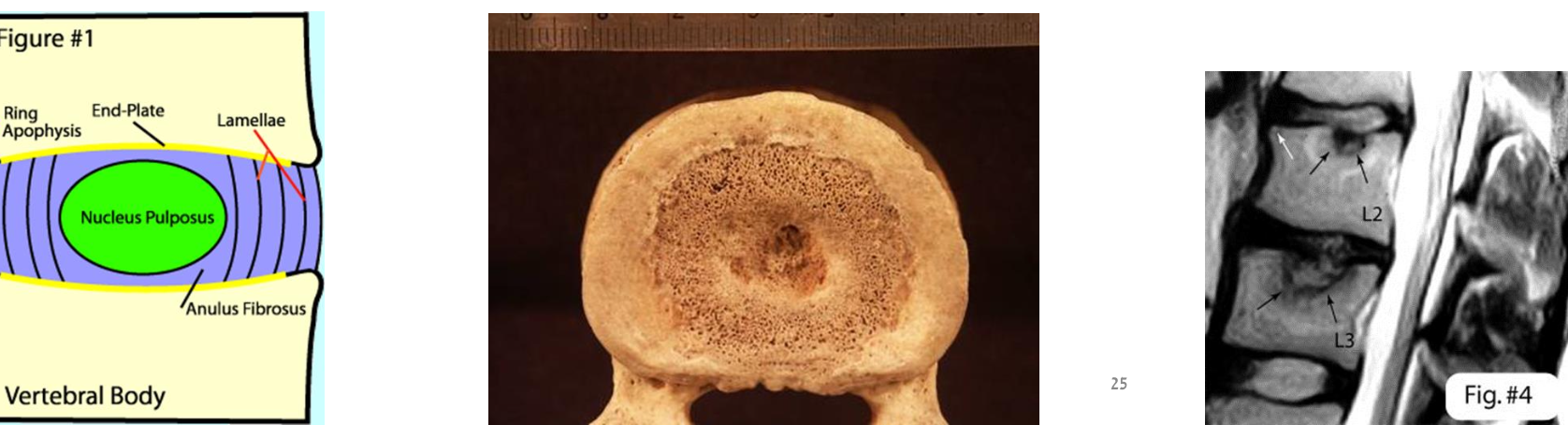 Vertebral end plate
