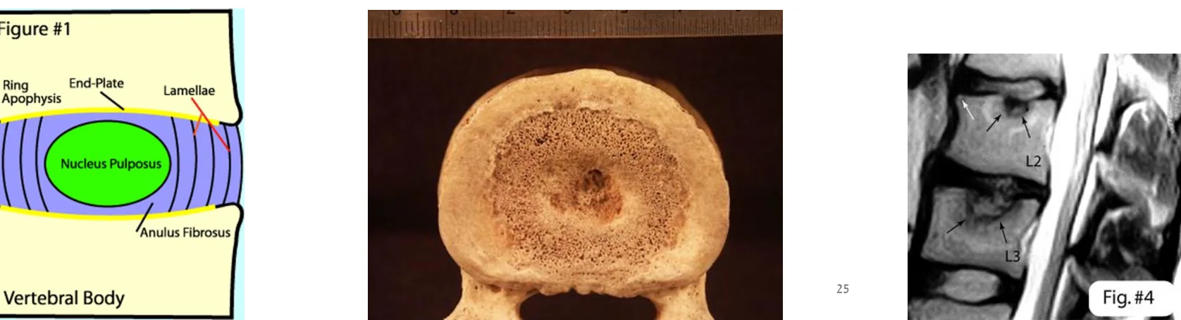 Vertebral End Plate