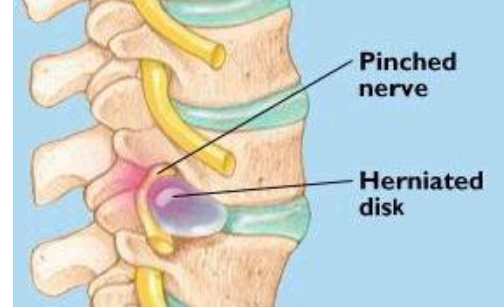 Herniated disk