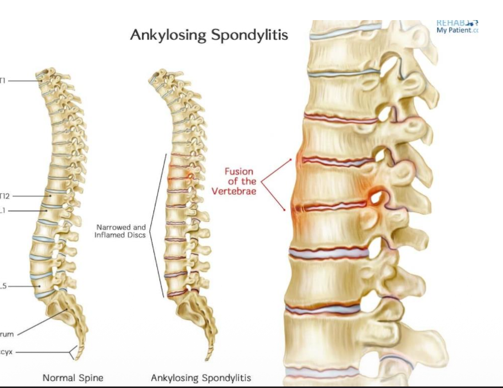 ankylosing spondylitis