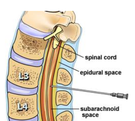 Lumbar cistern