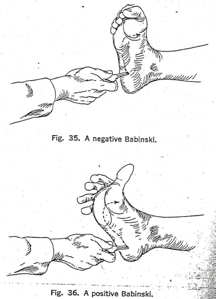 Babinski test