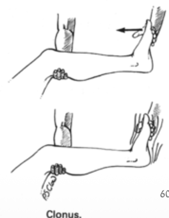 Clonus sign