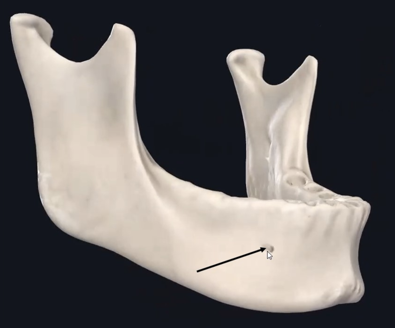 Mental Foramen