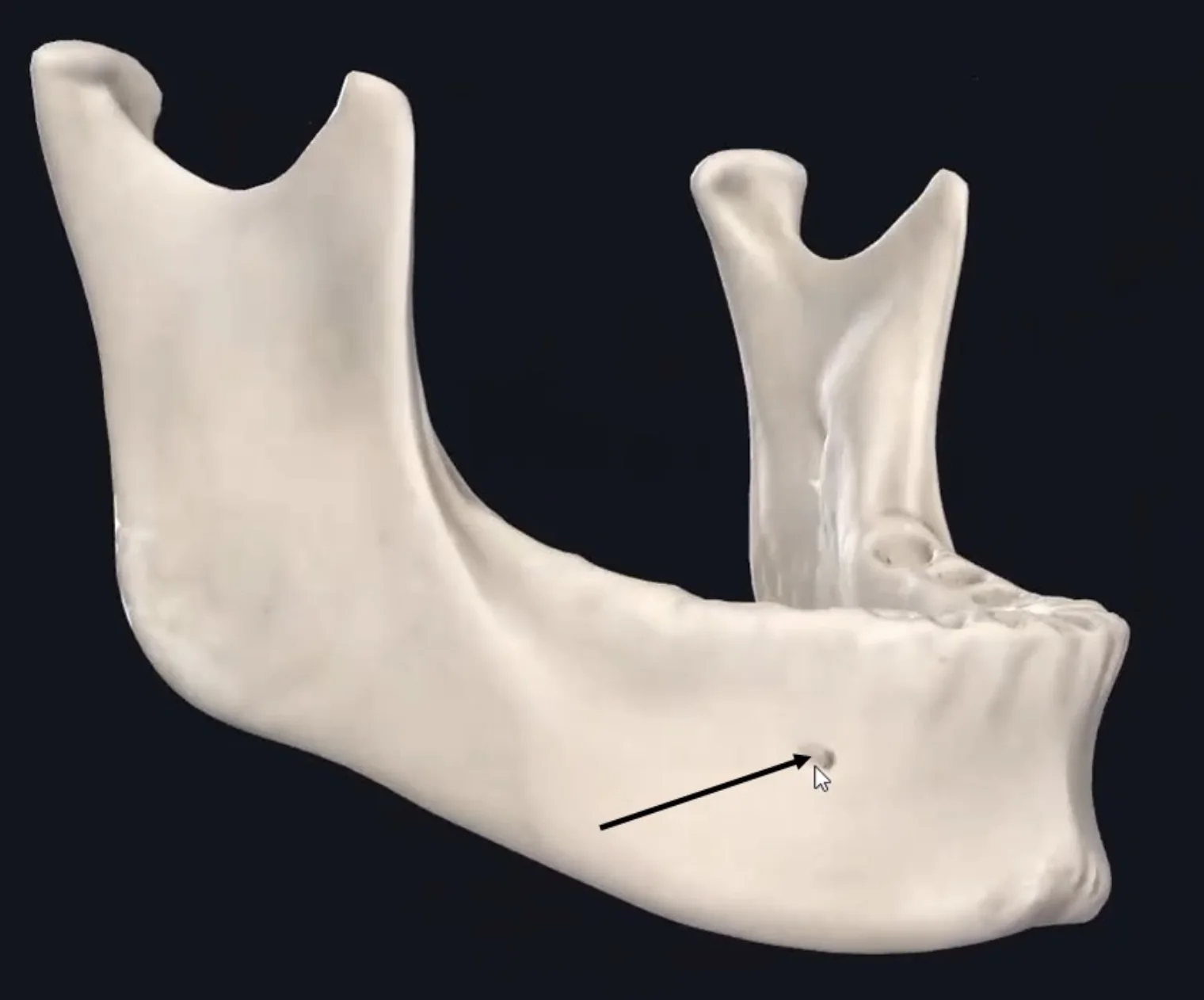 Mental Foramen