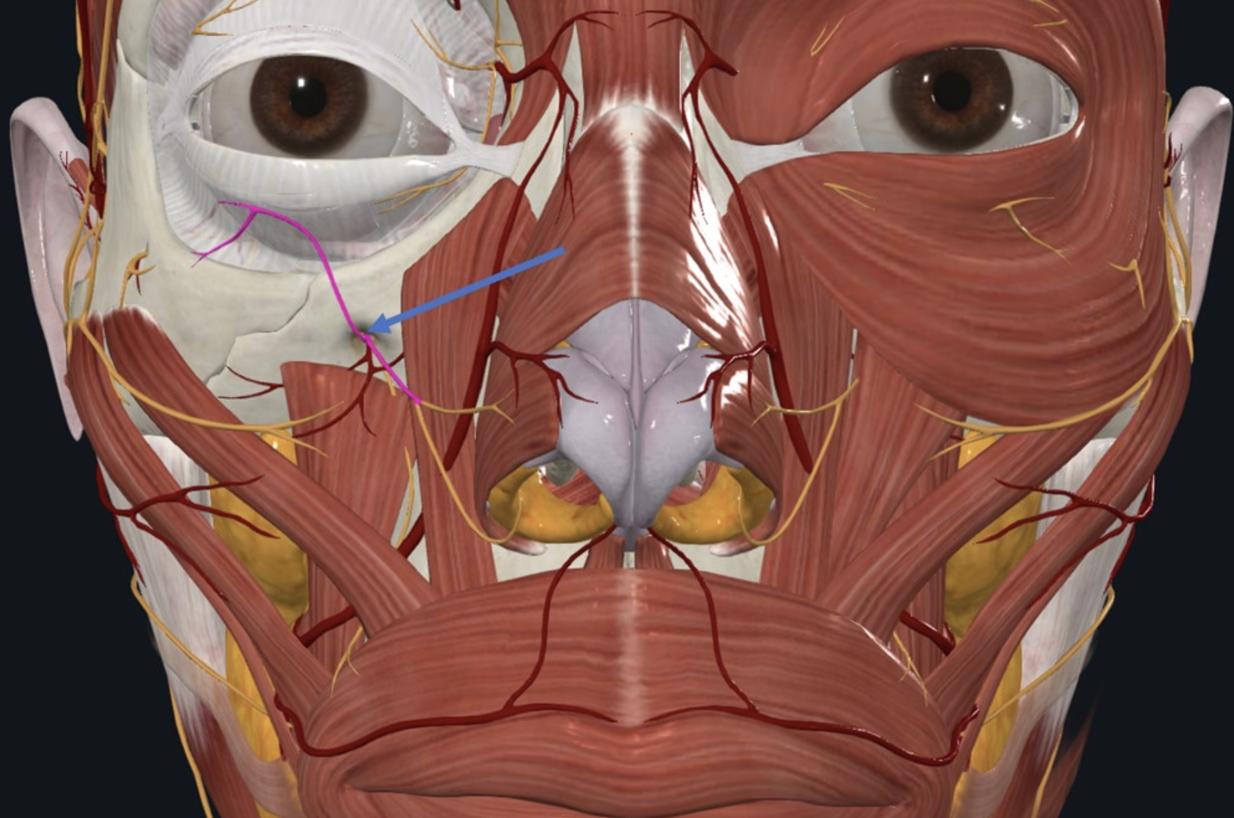 Infraorbital Nerve, מקורו ב־V2 והוא בוקע דרך ה־Infraorbital foramen