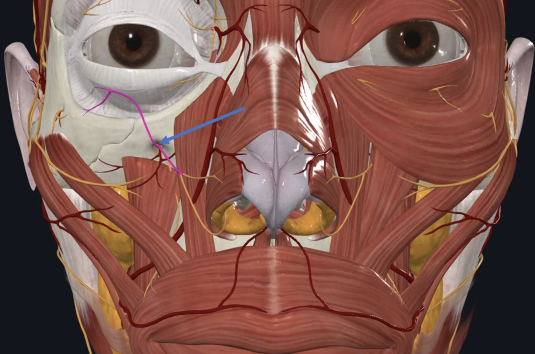 Infraorbital Nerve, מקורו ב־V2 והוא בוקע דרך ה־Infraorbital foramen
