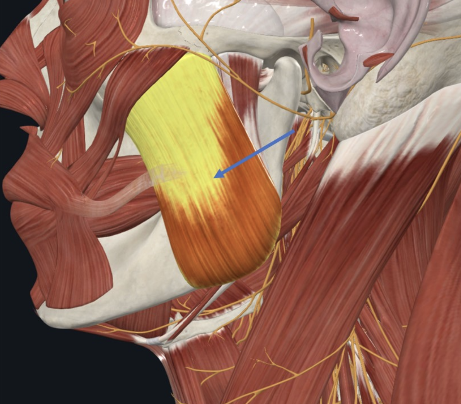Masseter, איננו מצוי ב־Infratemporal fossa אלא במשטח החיצוני של עצם ה־Mandyble