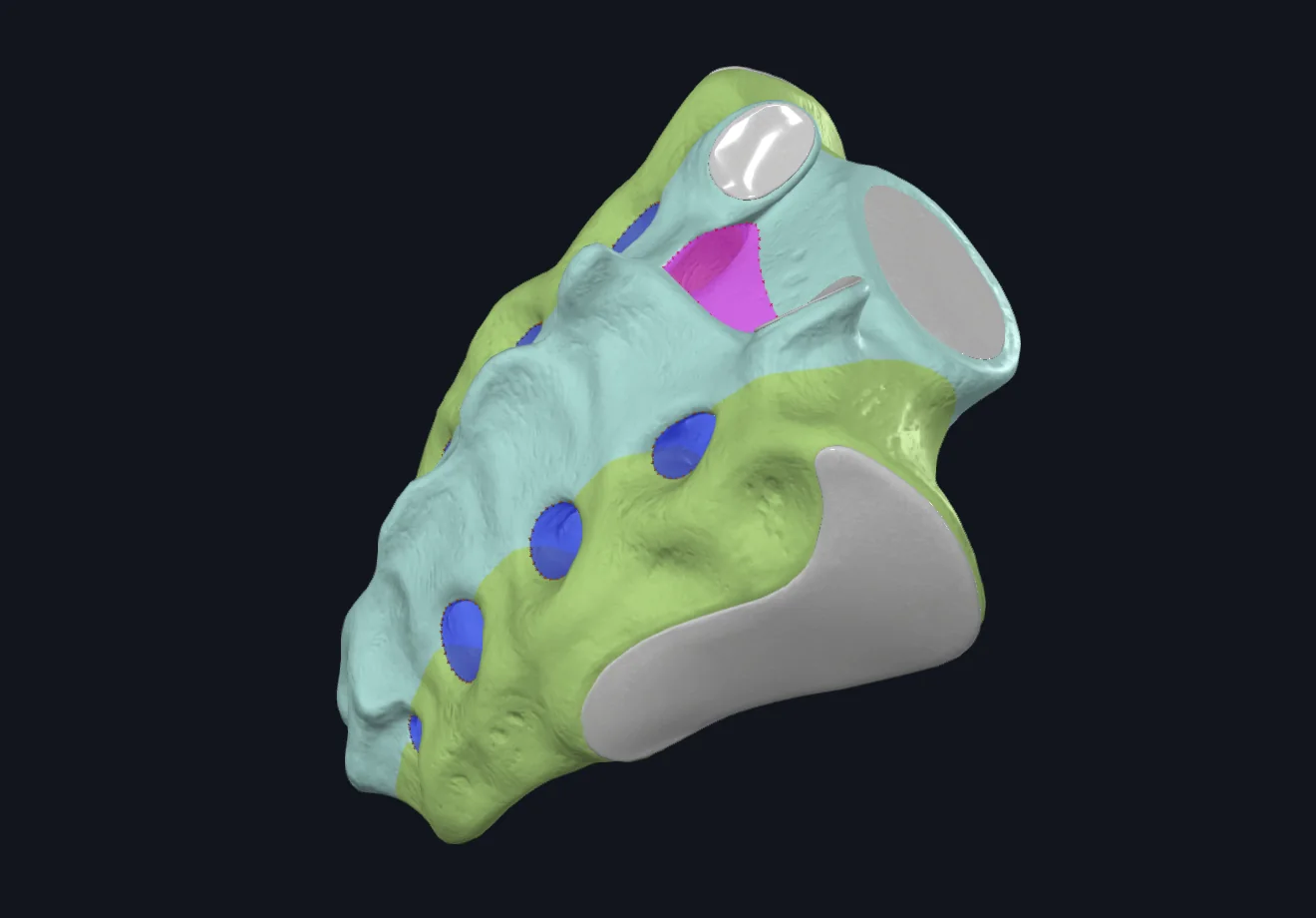 Sacral Canal
