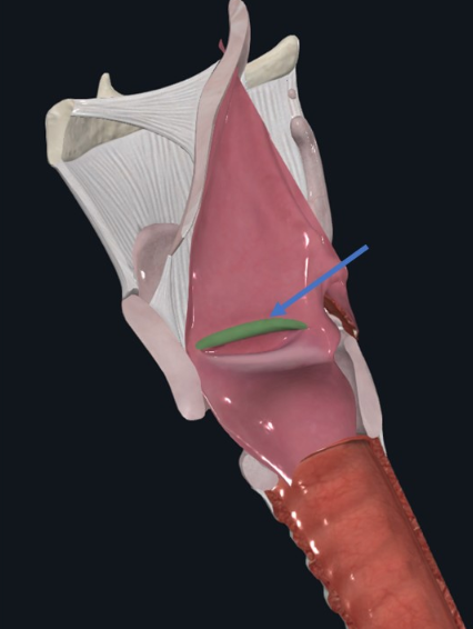 Vestibular fold - מיתרי הקול המדומים, נמצאים סופריורית למיתרי הקול האמיתיים ונועדו להגן עליהם