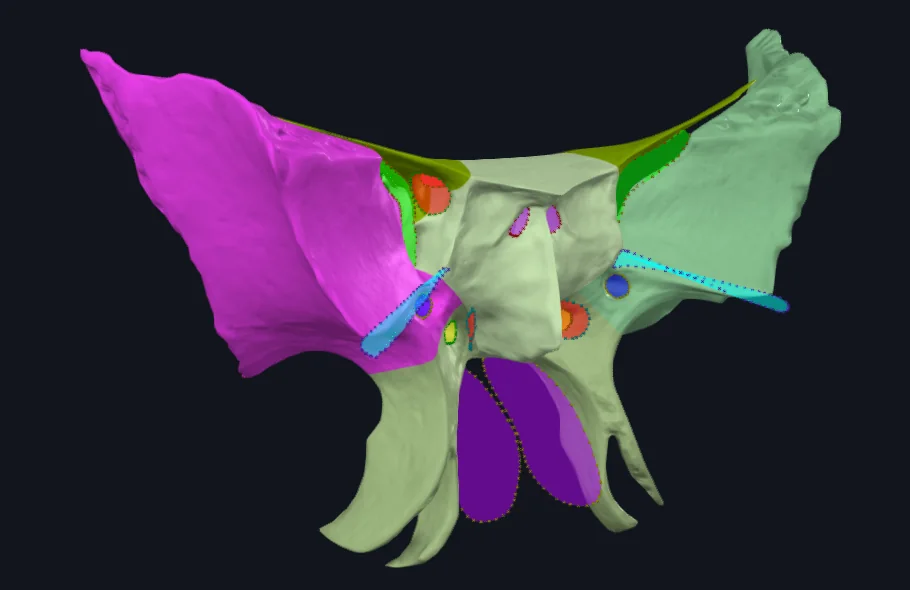 Greater Wing of Sphenoid bone