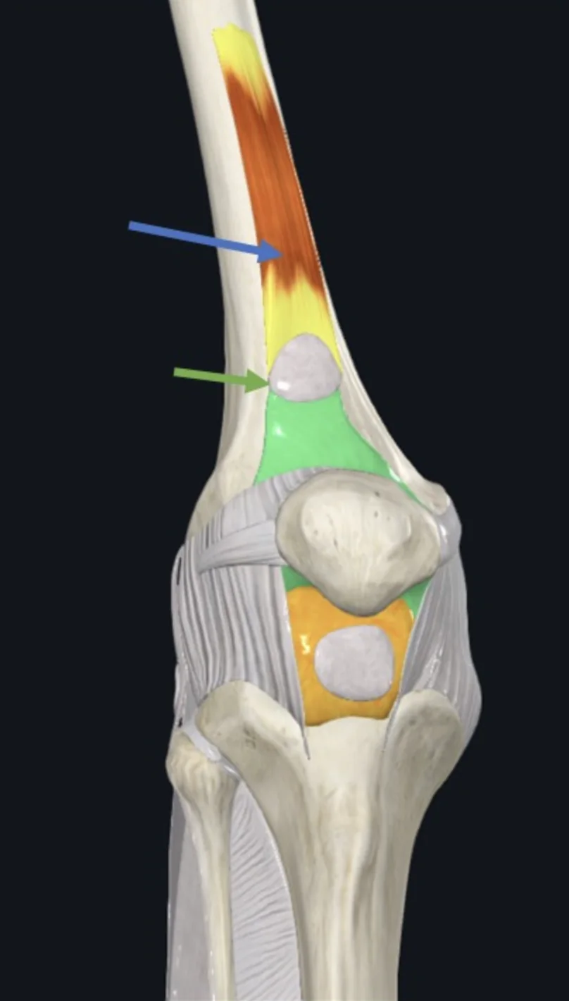 Articularis Genu (חץ כחול), והממברנה הסינוביאלית וה־Suprapatellar Bursa (חץ ירוק)