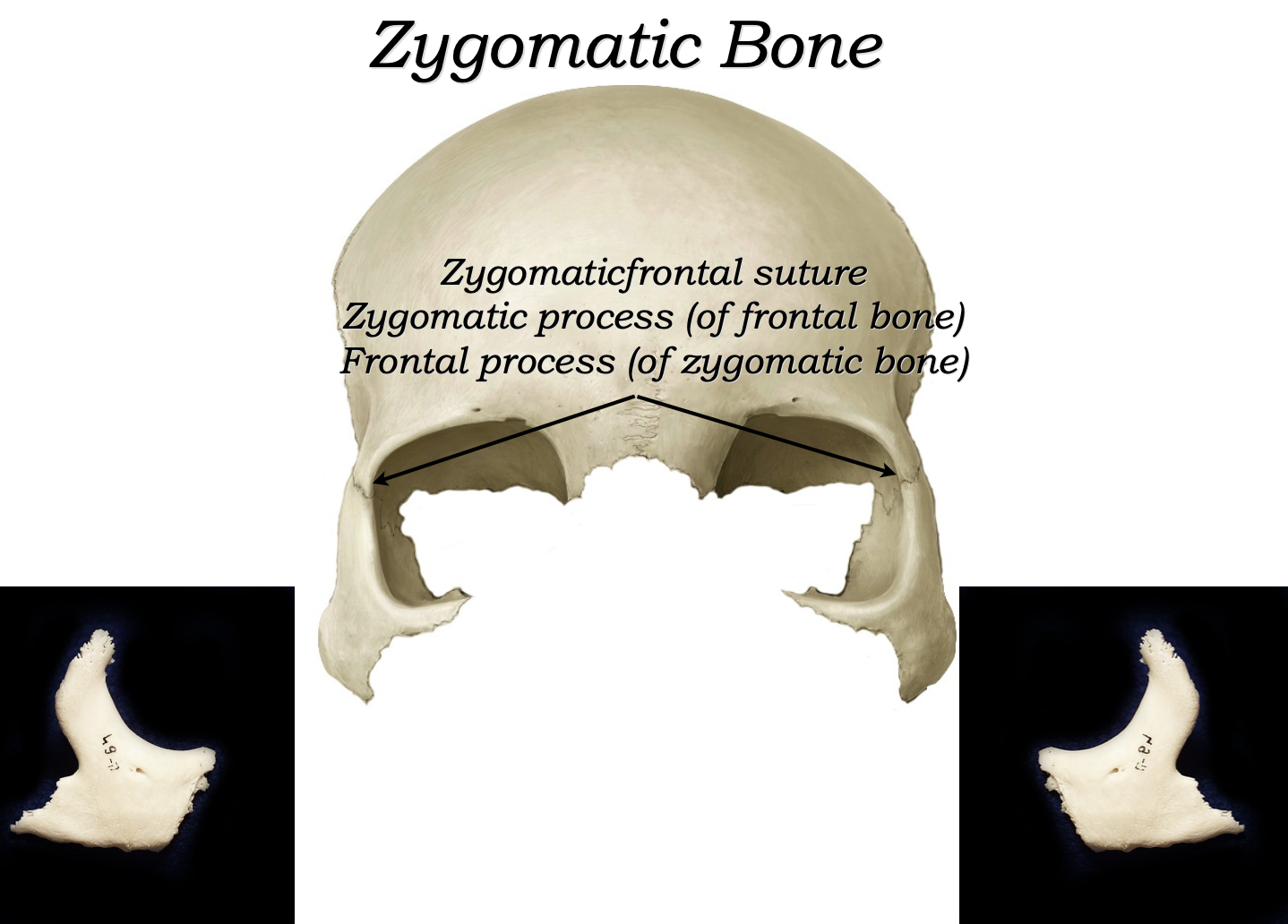 Zygomatic bones