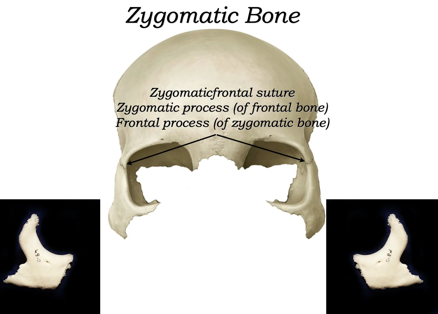 Zygomatic Bones