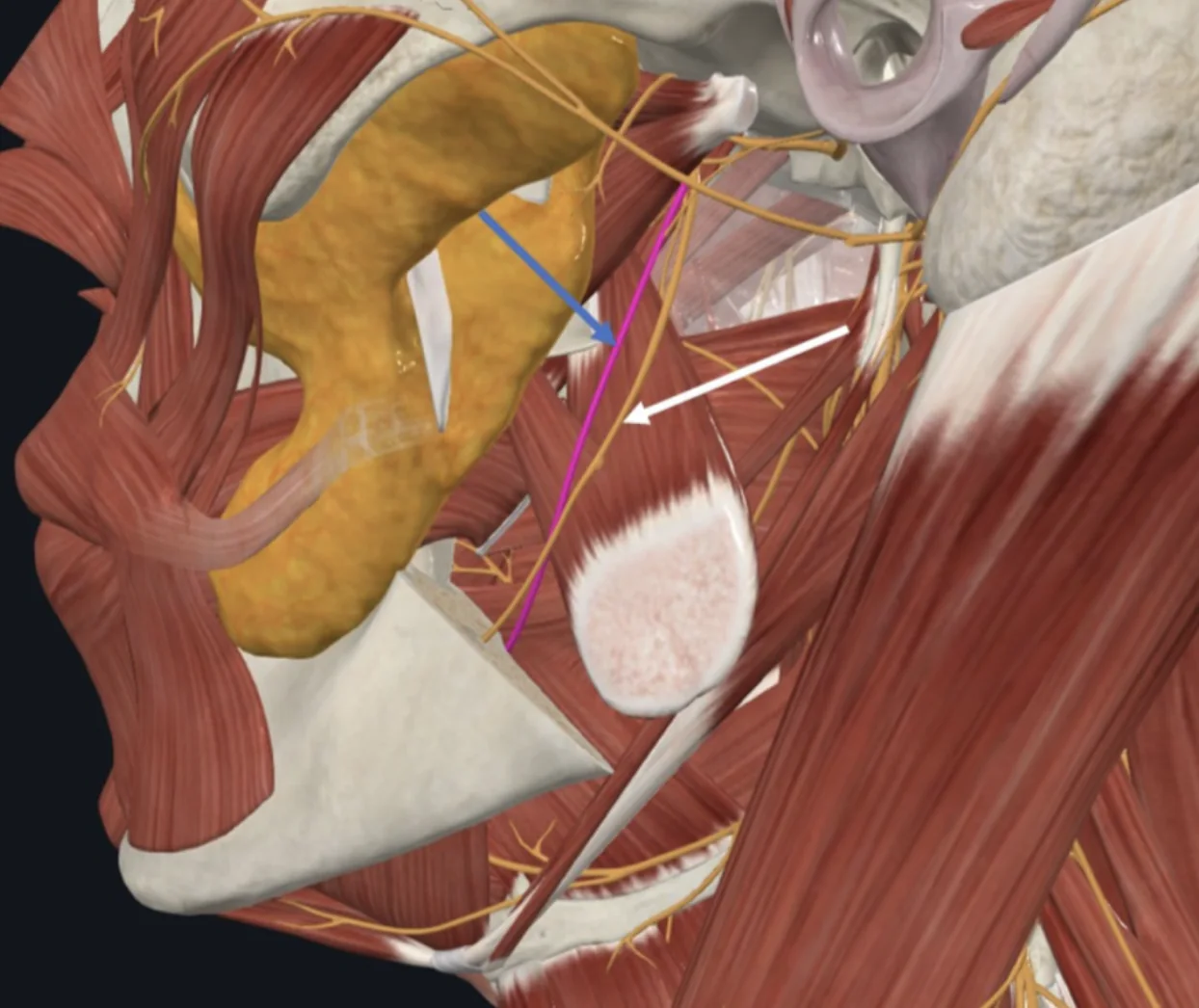 Inferior Alveolar Nerve (חץ לבן), ו־Lingul Nerve (חץ כחול)