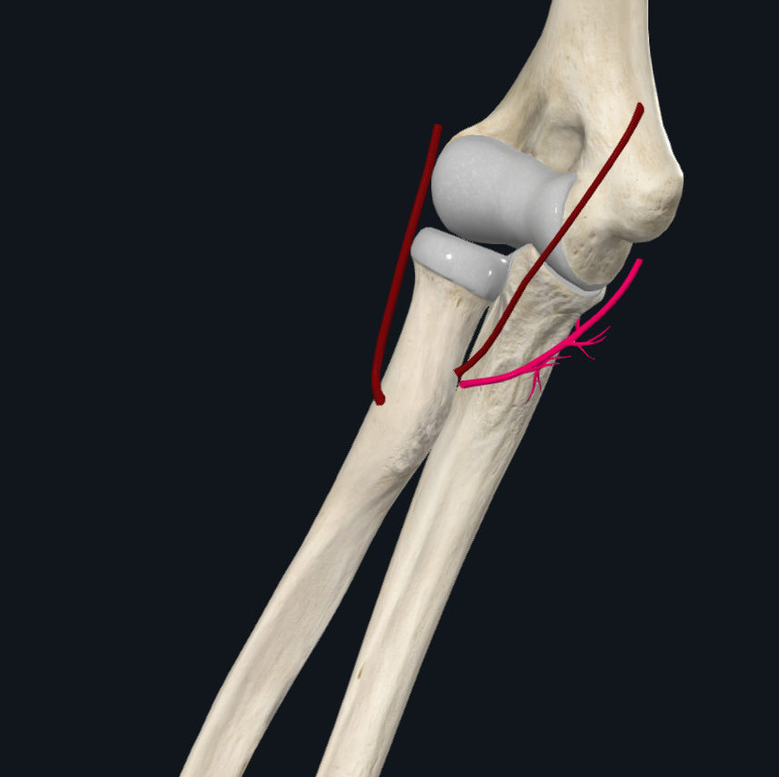 Posterior Ulnar Recurrent Artery (Right)